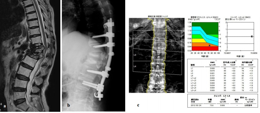 B62-115 X線フィルムから診断する骨粗鬆症 （参考X線フィルム 不揃い)